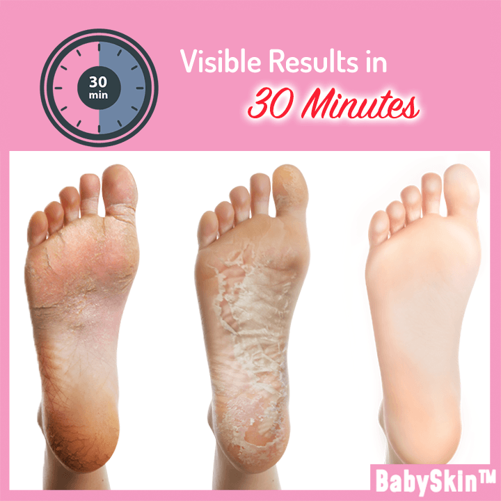 BabySkin™ Ultimate Foot Peeling Mask