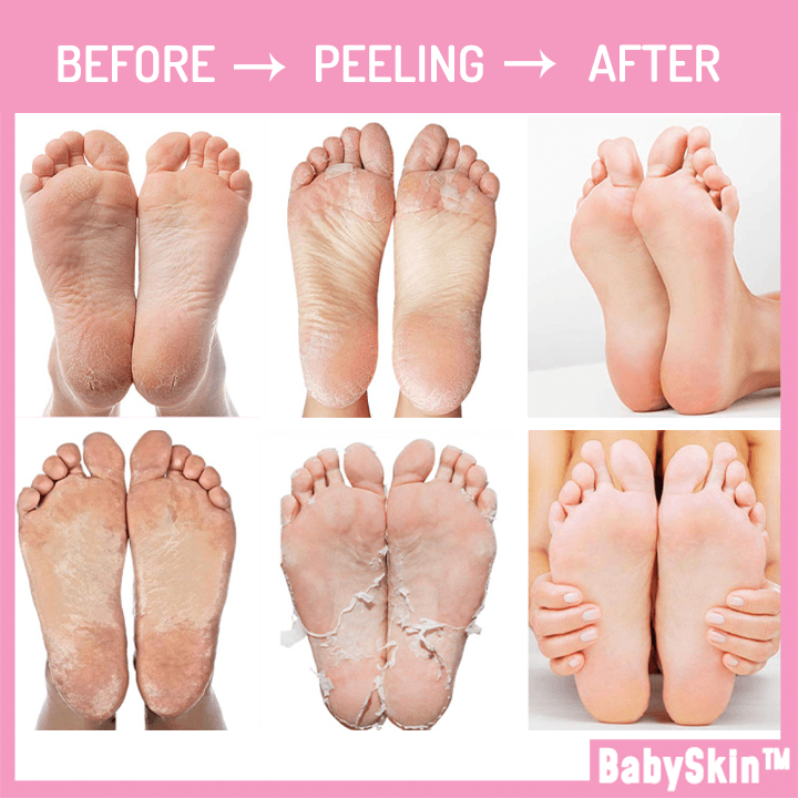 BabySkin™ Ultimate Foot Peeling Mask